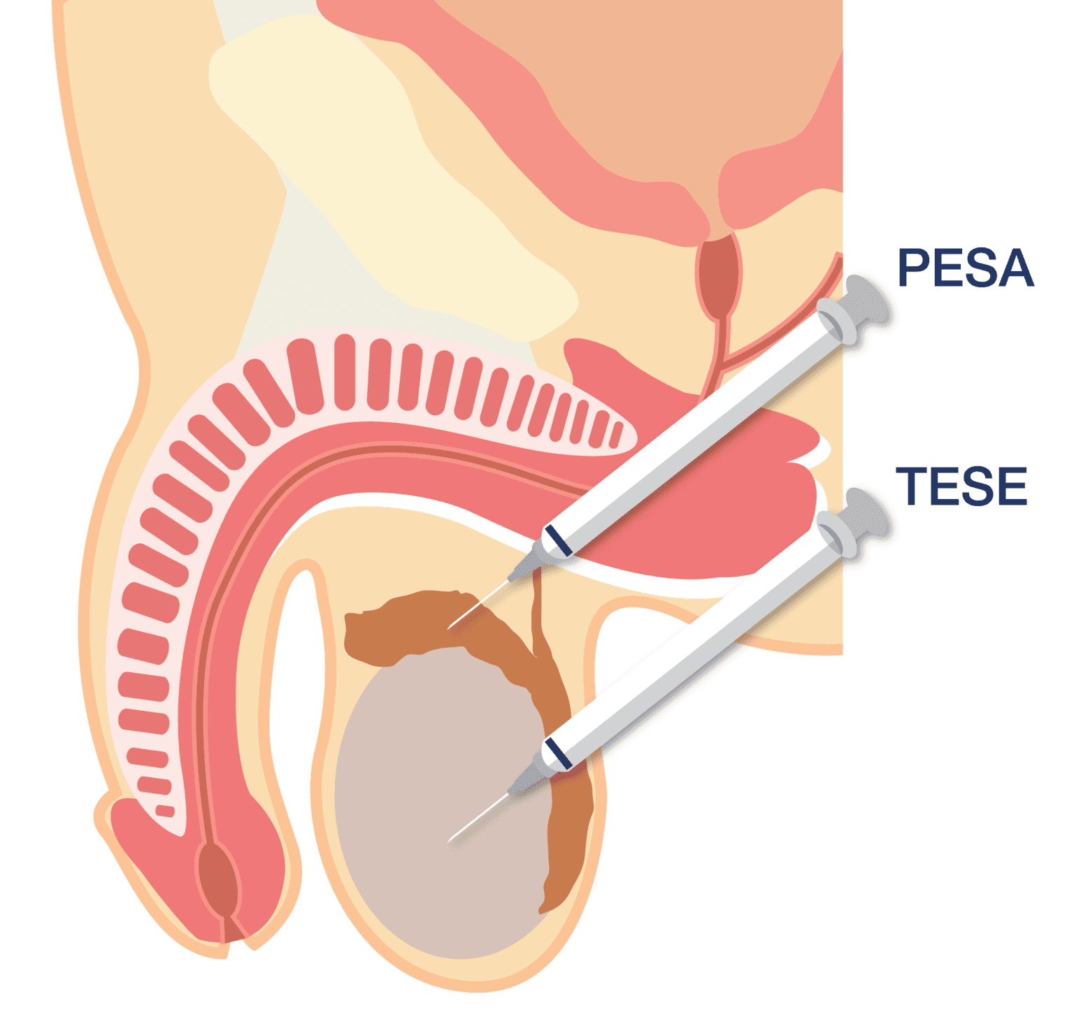 PESA/TESE睾丸穿刺精子提取技术